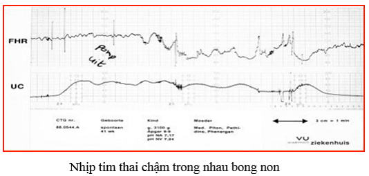 Monitoring sản khoa là gì