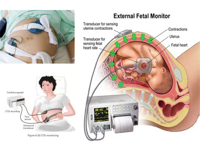 Monitoring sản khoa 